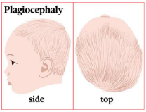 Plagiocephaly