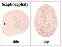 Scaphocephaly