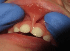 Red Flags for Tethered Oral Tissue