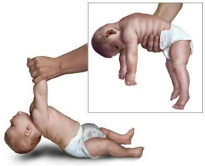 Low Muscle Tone in Babies