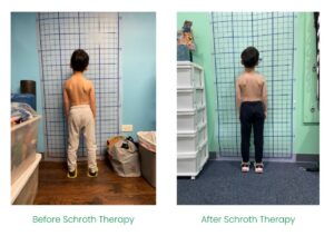 Before and After Schroth Therapy